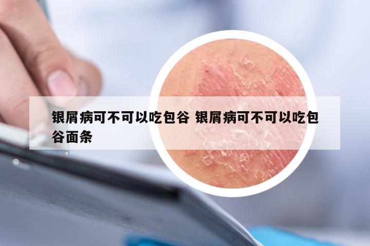 银屑病可不可以吃包谷 银屑病可不可以吃包谷面条