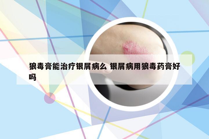 狼毒膏能治疗银屑病么 银屑病用狼毒药膏好吗