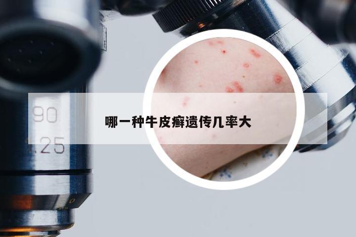 哪一种牛皮癣遗传几率大