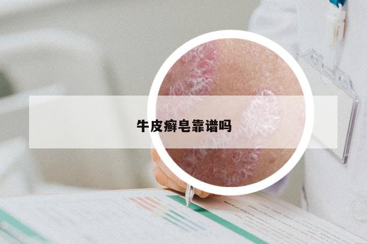牛皮癣皂靠谱吗