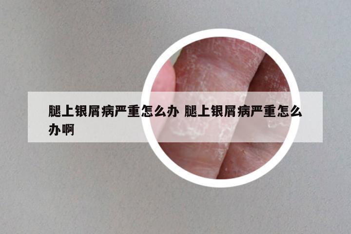 腿上银屑病严重怎么办 腿上银屑病严重怎么办啊