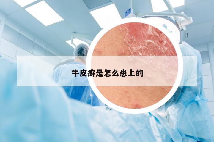 牛皮癣是怎么患上的