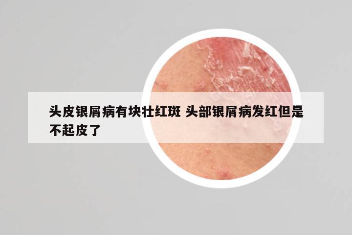 头皮银屑病有块壮红斑 头部银屑病发红但是不起皮了