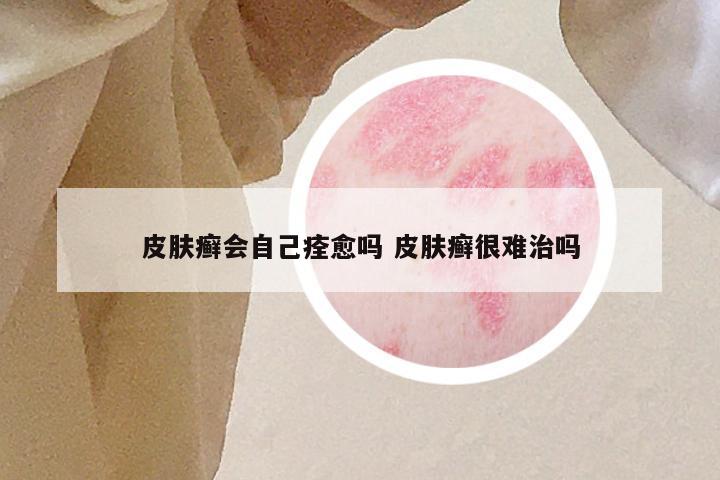 皮肤癣会自己痊愈吗 皮肤癣很难治吗