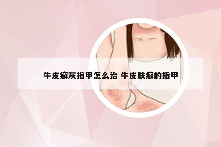 牛皮癣灰指甲怎么治 牛皮肤癣的指甲