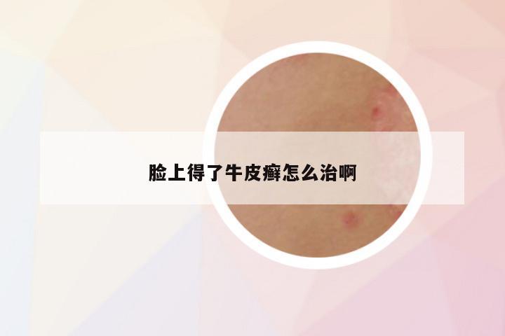 脸上得了牛皮癣怎么治啊
