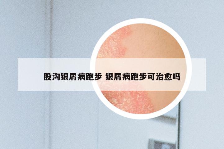 股沟银屑病跑步 银屑病跑步可治愈吗