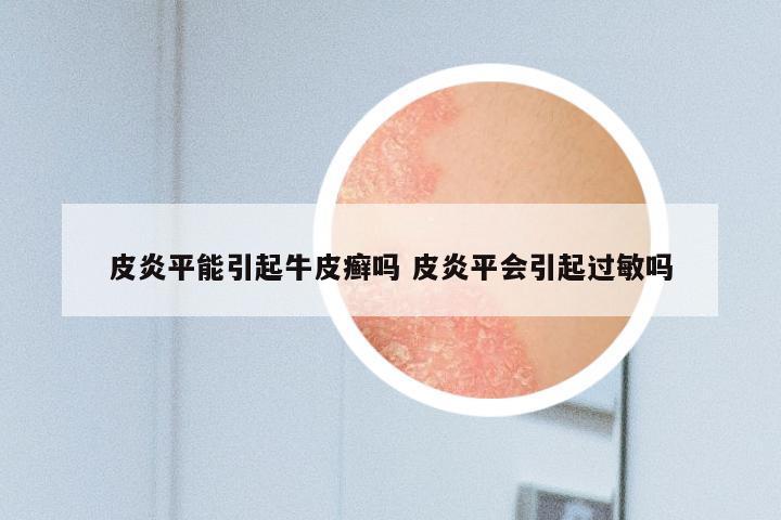 皮炎平能引起牛皮癣吗 皮炎平会引起过敏吗