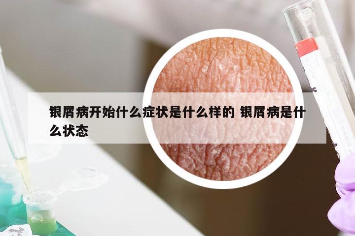 银屑病开始什么症状是什么样的 银屑病是什么状态