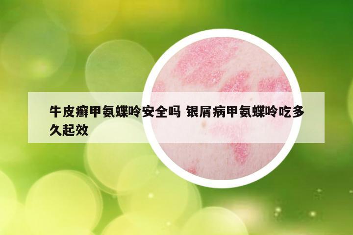 牛皮癣甲氨蝶呤安全吗 银屑病甲氨蝶呤吃多久起效