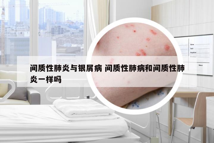 间质性肺炎与银屑病 间质性肺病和间质性肺炎一样吗