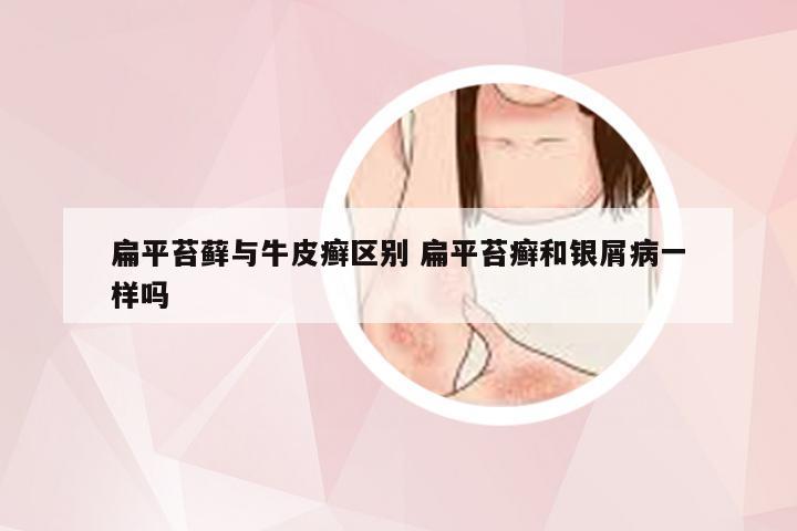 扁平苔藓与牛皮癣区别 扁平苔癣和银屑病一样吗
