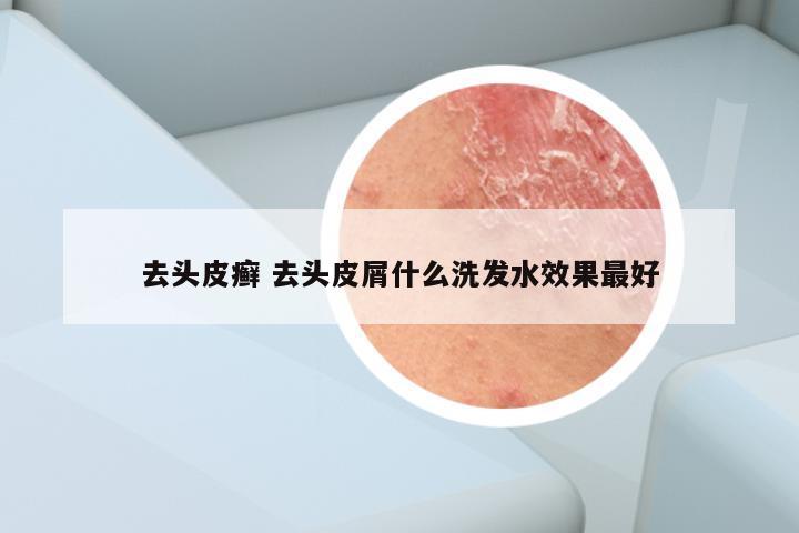 去头皮癣 去头皮屑什么洗发水效果最好