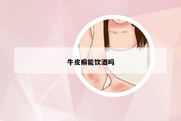 牛皮癣能饮酒吗