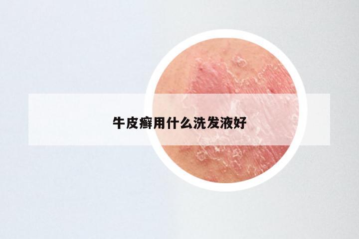牛皮癣用什么洗发液好