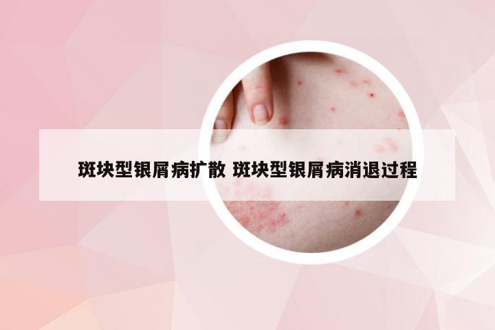 斑块型银屑病扩散 斑块型银屑病消退过程