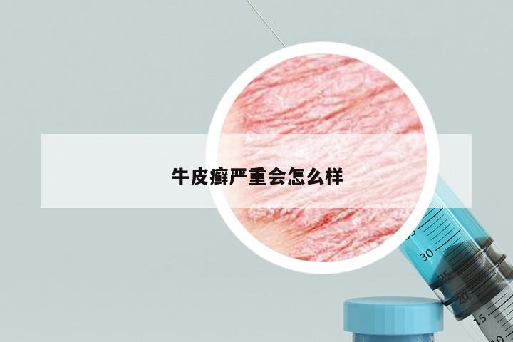 牛皮癣严重会怎么样