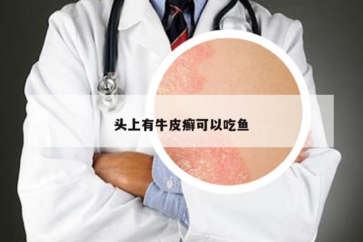 头上有牛皮癣可以吃鱼