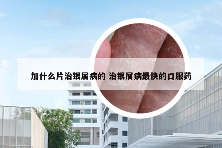 加什么片治银屑病的 治银屑病最快的口服药