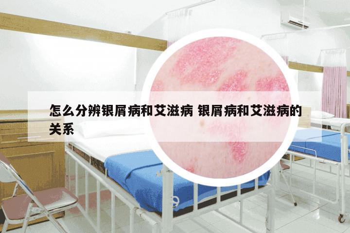 怎么分辨银屑病和艾滋病 银屑病和艾滋病的关系
