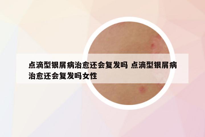 点滴型银屑病治愈还会复发吗 点滴型银屑病治愈还会复发吗女性