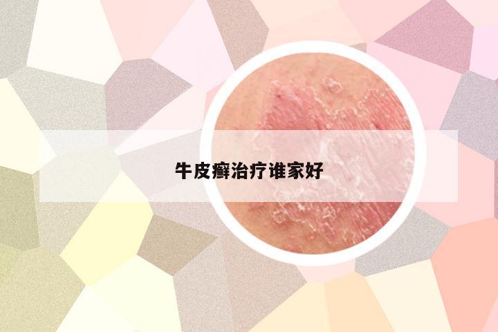 牛皮癣治疗谁家好