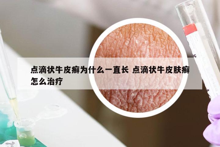 点滴状牛皮癣为什么一直长 点滴状牛皮肤癣怎么治疗