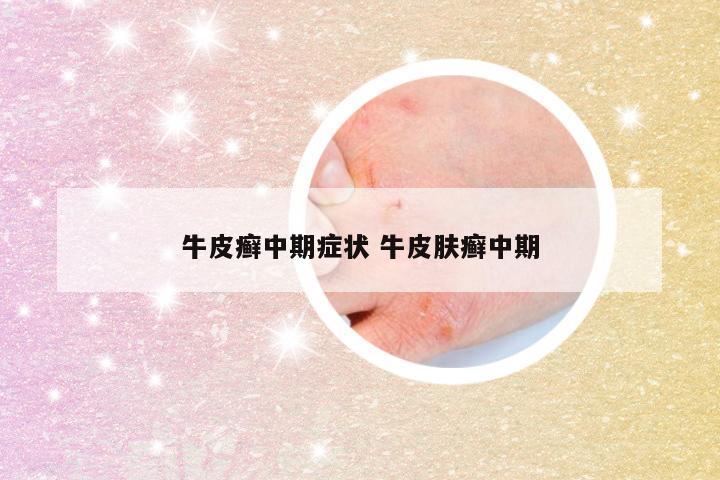 牛皮癣中期症状 牛皮肤癣中期