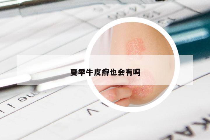 夏季牛皮癣也会有吗