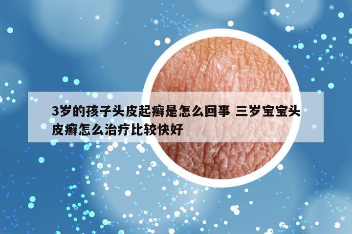 3岁的孩子头皮起癣是怎么回事 三岁宝宝头皮癣怎么治疗比较快好