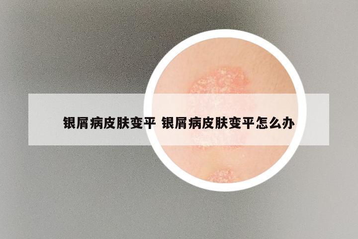 银屑病皮肤变平 银屑病皮肤变平怎么办
