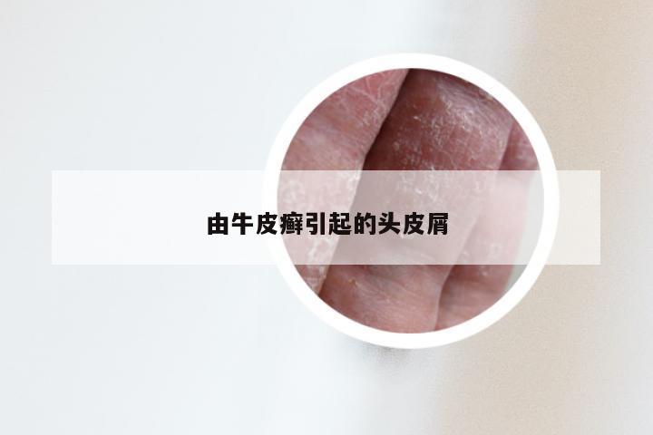由牛皮癣引起的头皮屑