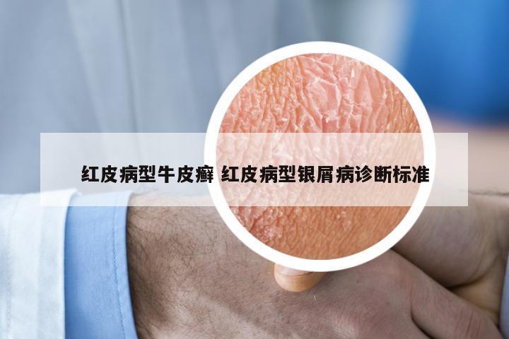 红皮病型牛皮癣 红皮病型银屑病诊断标准
