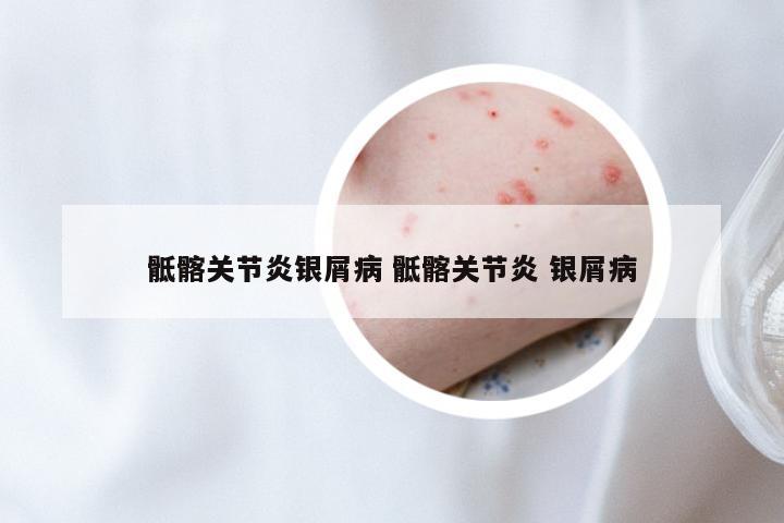 骶髂关节炎银屑病 骶髂关节炎 银屑病