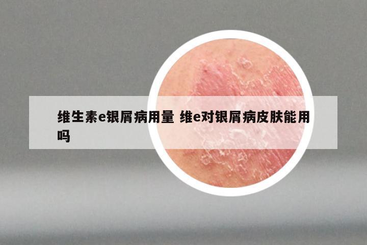 维生素e银屑病用量 维e对银屑病皮肤能用吗