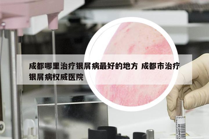 成都哪里治疗银屑病最好的地方 成都市治疗银屑病权威医院