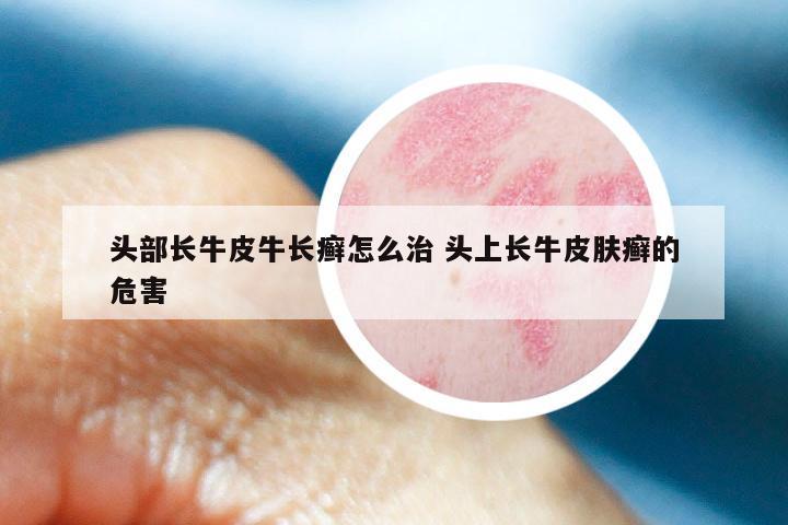 头部长牛皮牛长癣怎么治 头上长牛皮肤癣的危害