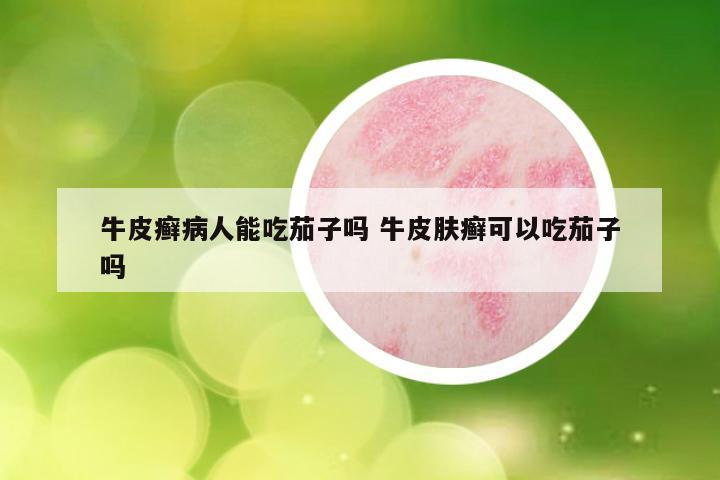 牛皮癣病人能吃茄子吗 牛皮肤癣可以吃茄子吗
