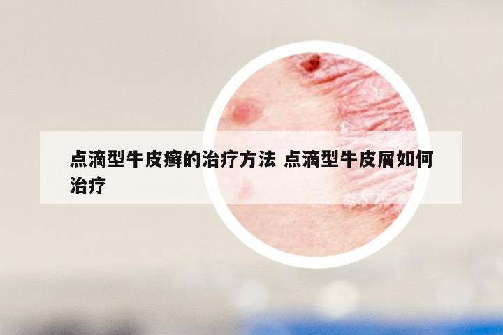 点滴型牛皮癣的治疗方法 点滴型牛皮屑如何治疗