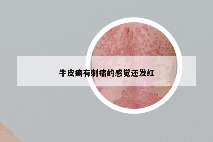 牛皮癣有刺痛的感觉还发红