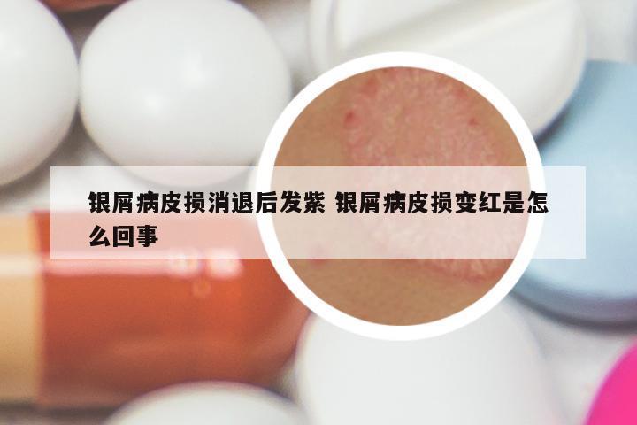 银屑病皮损消退后发紫 银屑病皮损变红是怎么回事