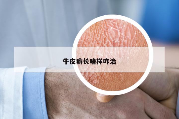牛皮癣长啥样咋治
