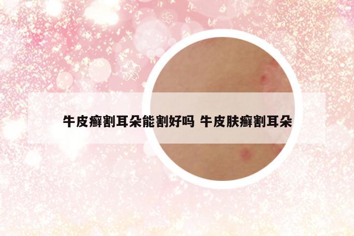 牛皮癣割耳朵能割好吗 牛皮肤癣割耳朵