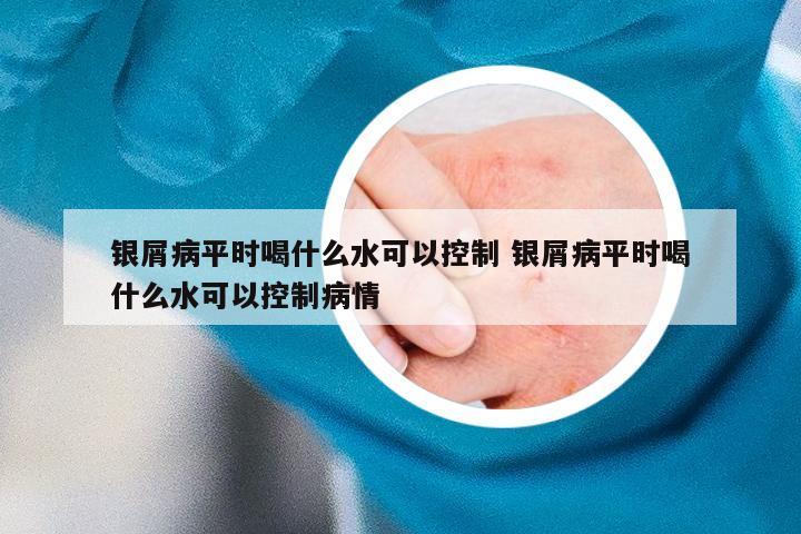 银屑病平时喝什么水可以控制 银屑病平时喝什么水可以控制病情