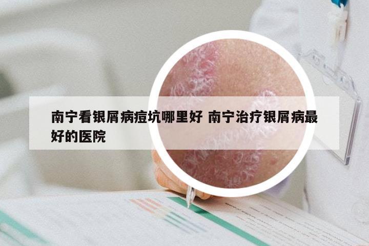 南宁看银屑病痘坑哪里好 南宁治疗银屑病最好的医院