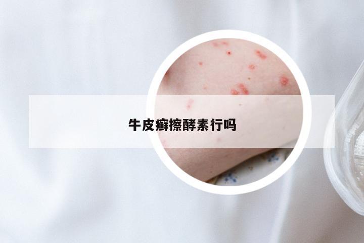 牛皮癣擦酵素行吗