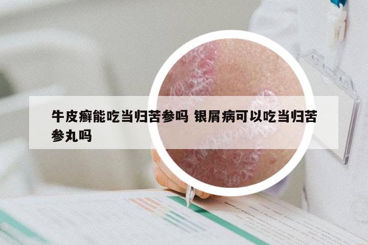牛皮癣能吃当归苦参吗 银屑病可以吃当归苦参丸吗