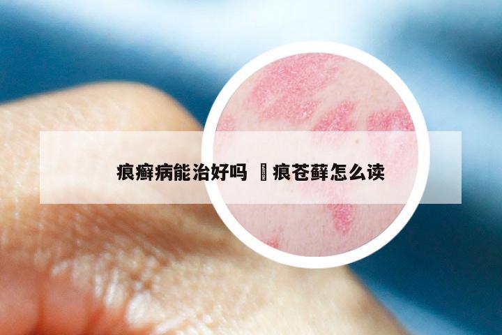 痕癣病能治好吗 屧痕苍藓怎么读