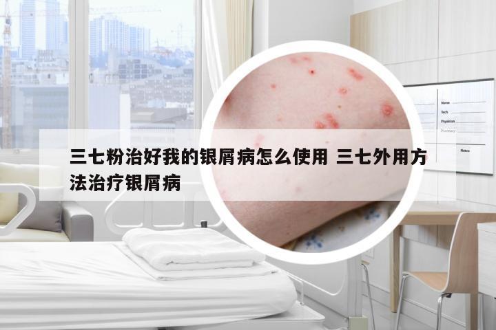 三七粉治好我的银屑病怎么使用 三七外用方法治疗银屑病