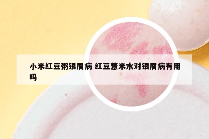 小米红豆粥银屑病 红豆薏米水对银屑病有用吗